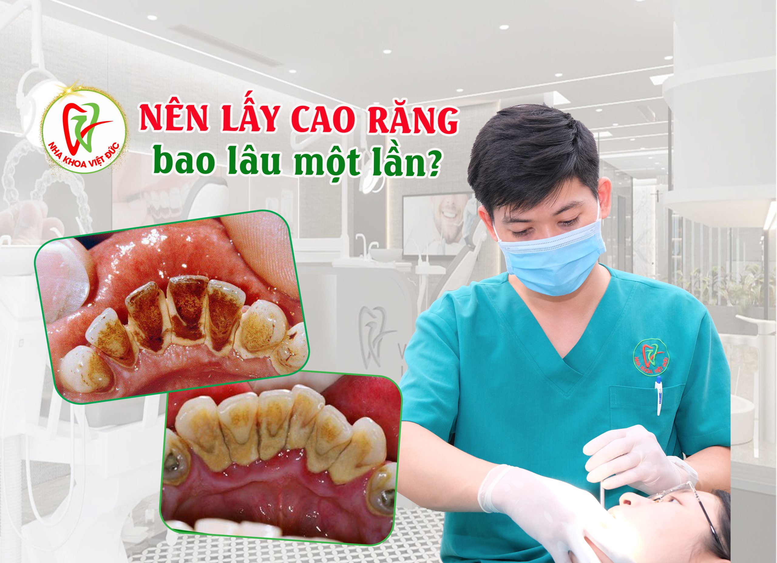 NÊN LẤY CAO RĂNG BAO LÂU MỘT LẦN?