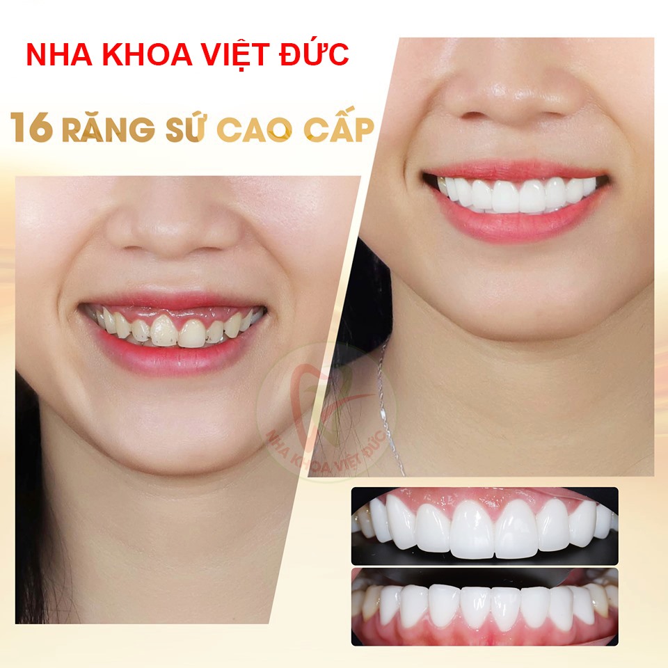 BỌC RĂNG SỨ THẨM MỸ