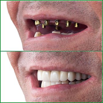 CẤY GHÉP IMPLANT