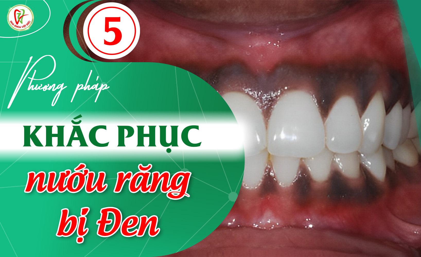 5 PHƯƠNG PHÁP KHẮC PHỤC NƯỚU RĂNG BỊ ĐEN