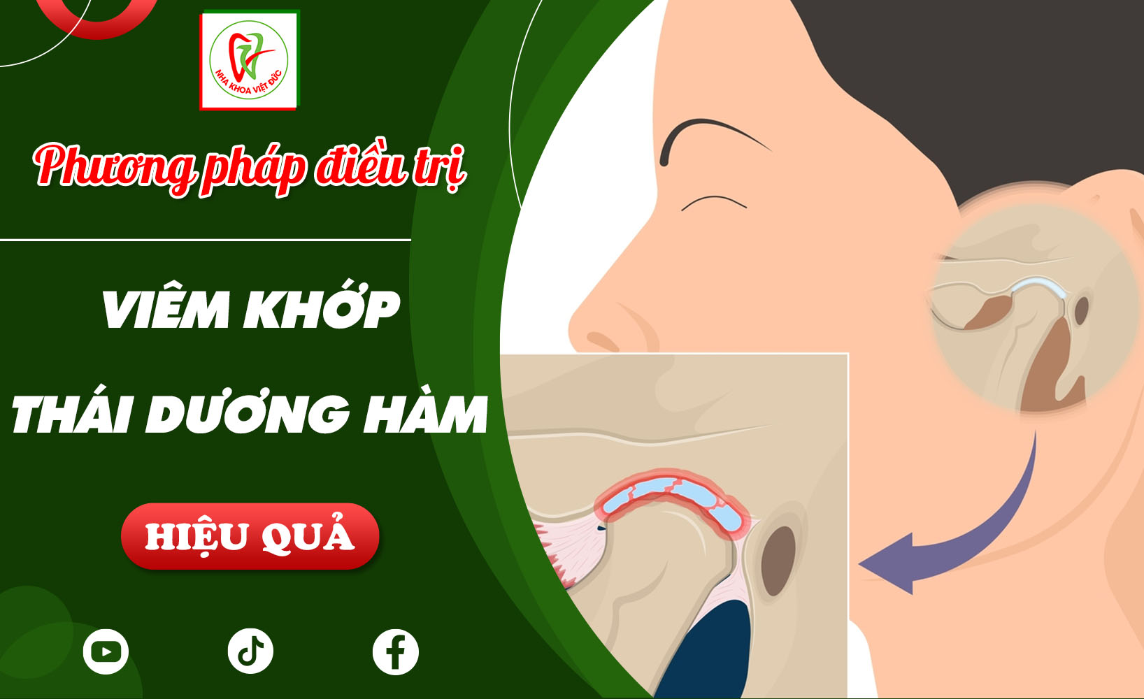 PHƯƠNG PHÁP ĐIỀU TRỊ VIÊM KHỚP THÁI DƯƠNG HÀM HIỆU QUẢ