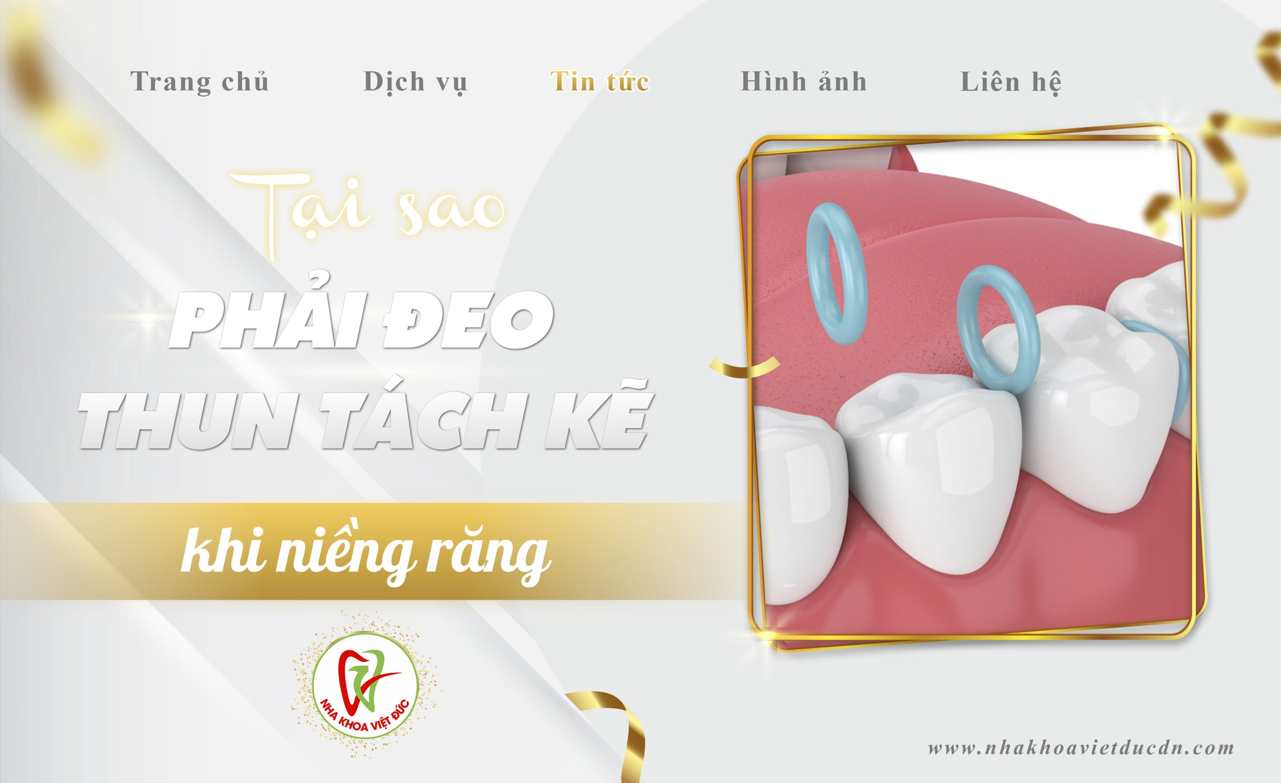 TẠI SAO PHẢI ĐEO THUN TÁCH KẼ KHI NIỀNG RĂNG?