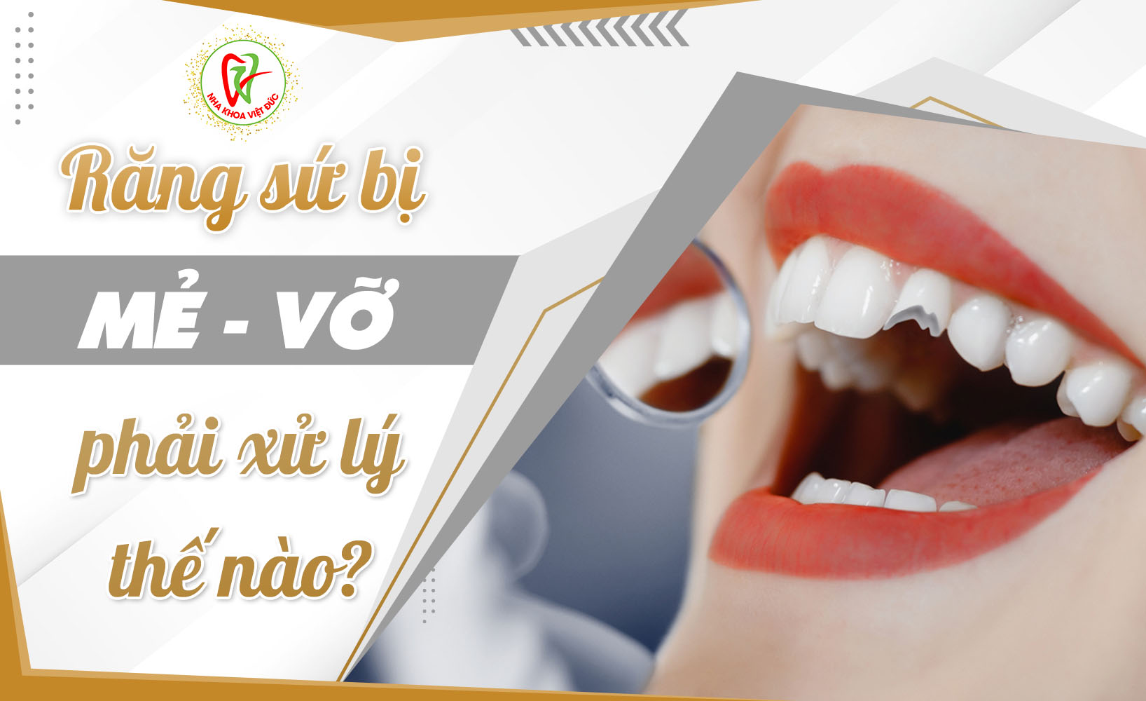 RĂNG SỨ BỊ MẺ VỠ PHẢI XỬ LÝ THẾ NÀO?